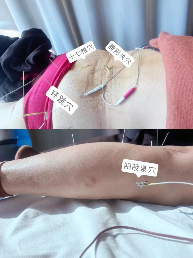 腰椎管狭窄针灸哪里