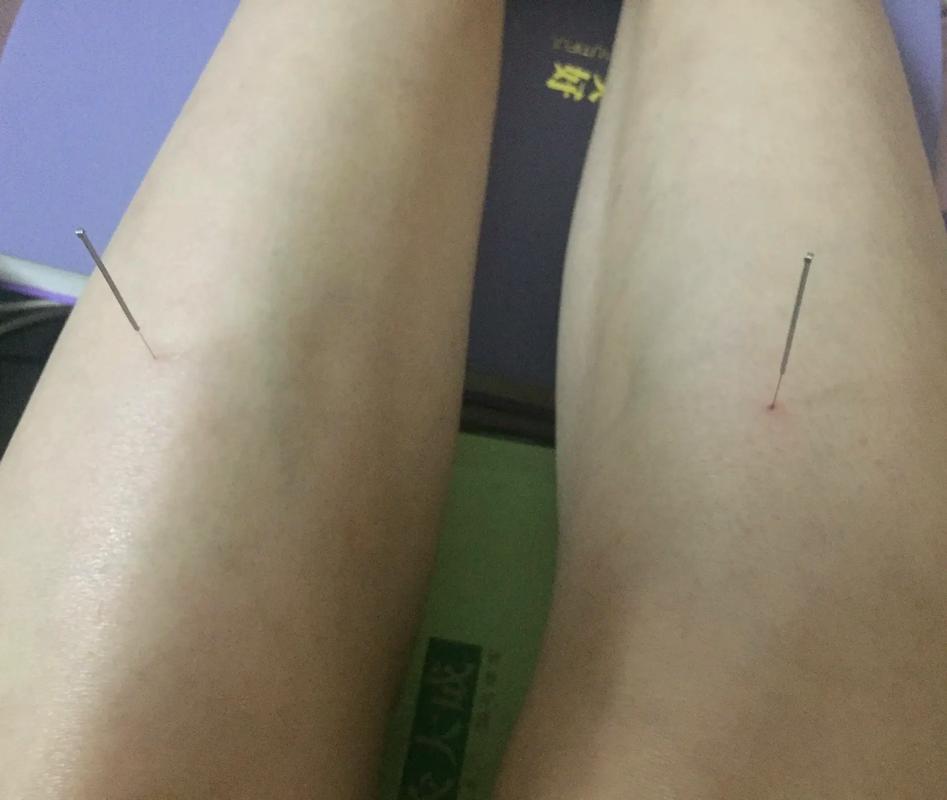 针灸调理肠胃要多久