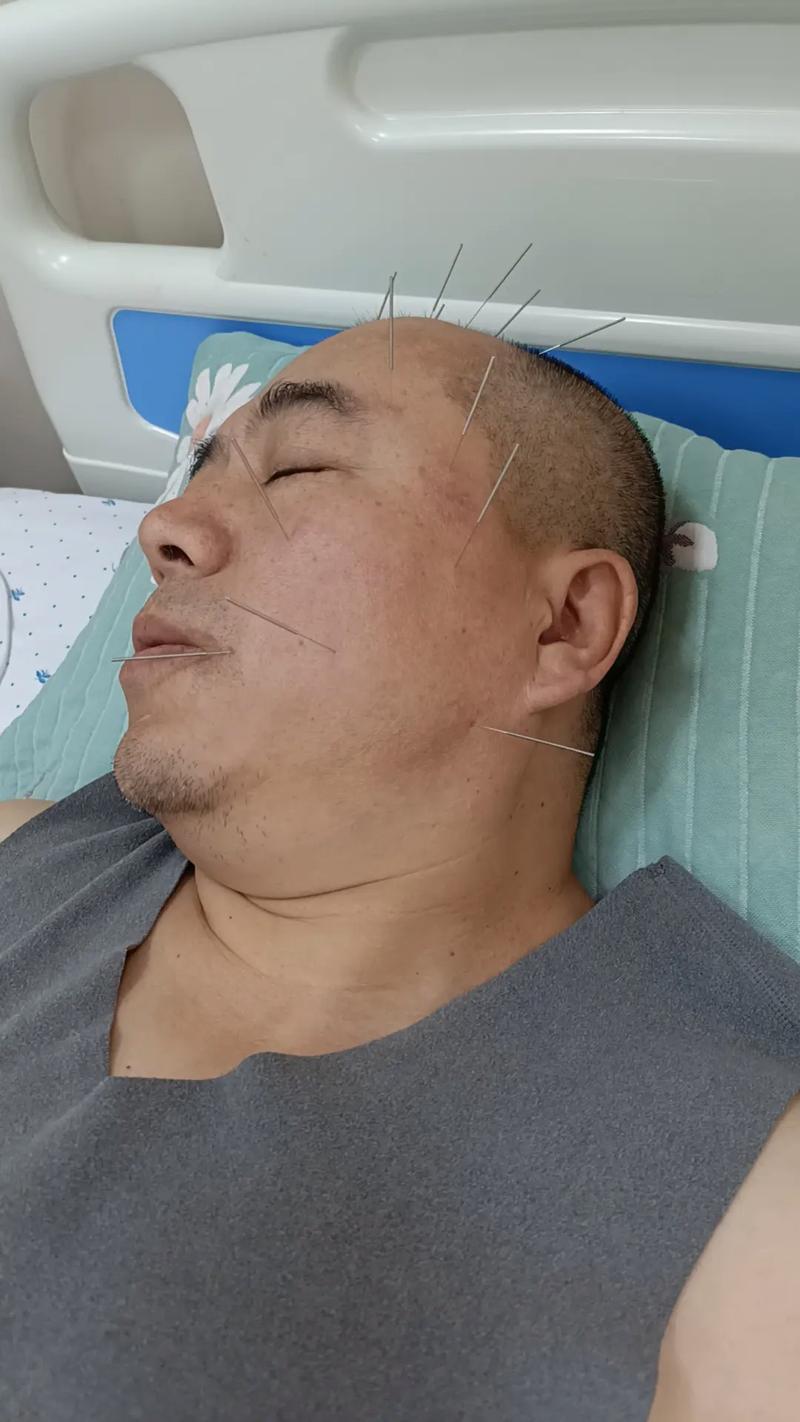 针灸扎到神经要紧吗