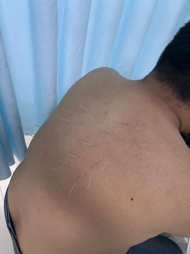 胆汁淤积从中医针灸