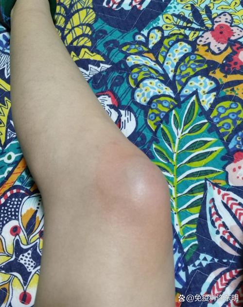 膝盖什么部位疼是痛风