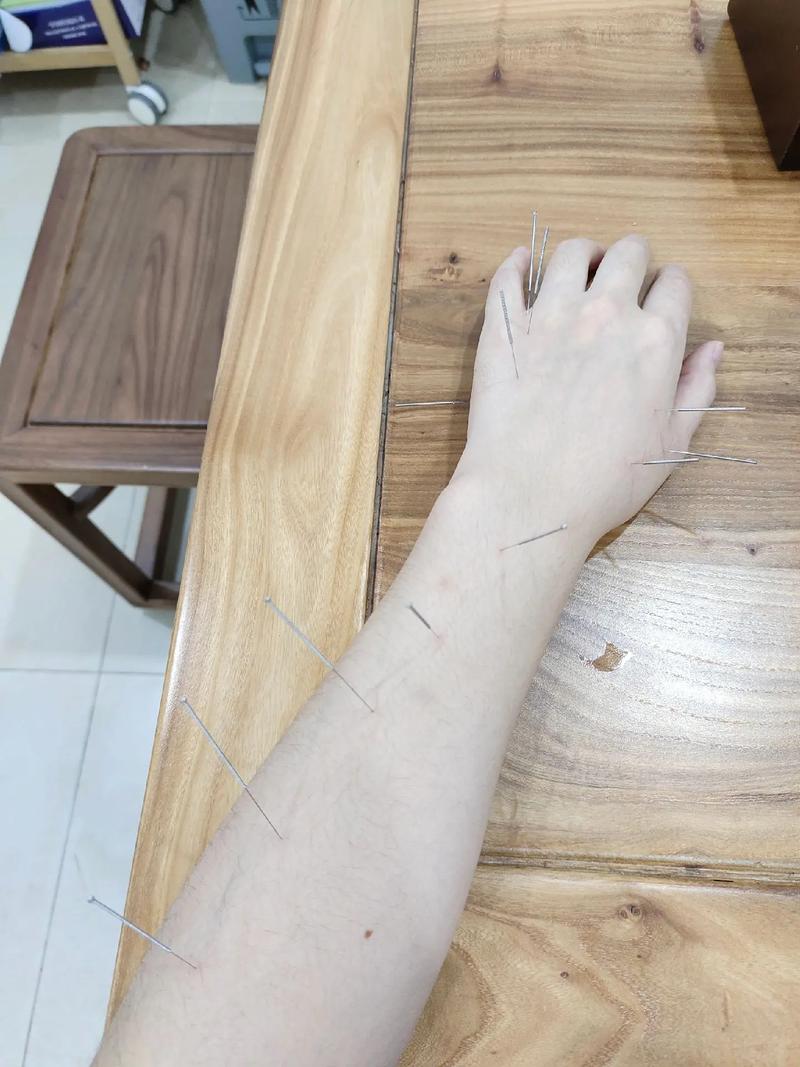 急性腰扭伤针灸方法