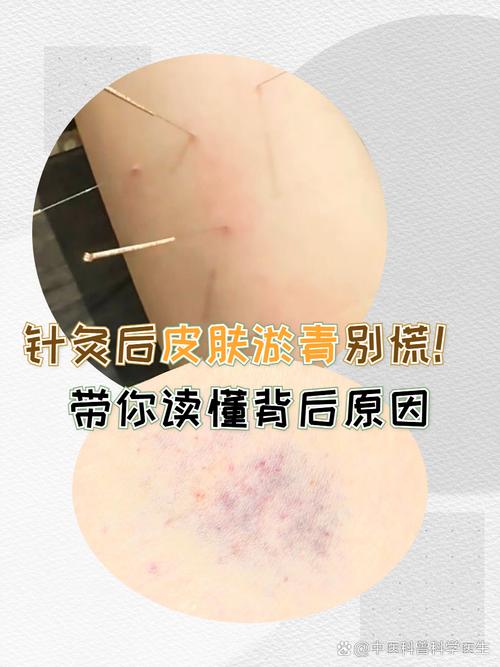 针灸之后有什么反应