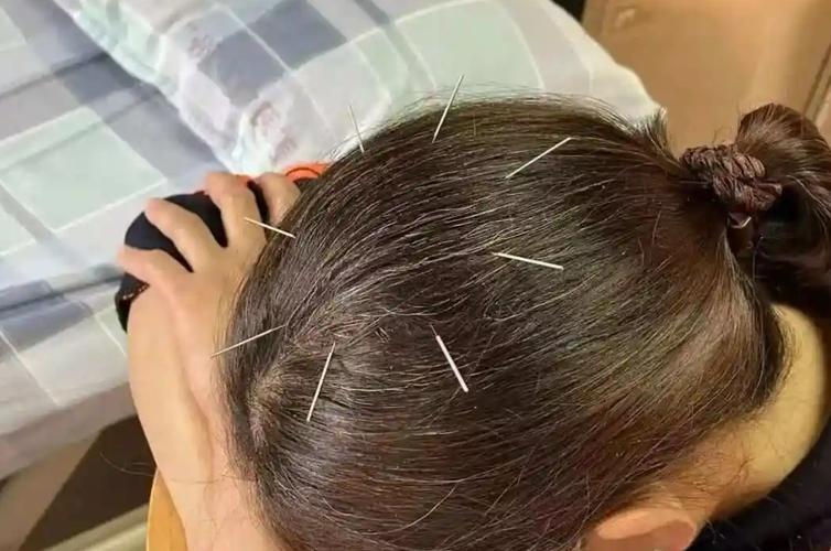 针灸之后有什么反应