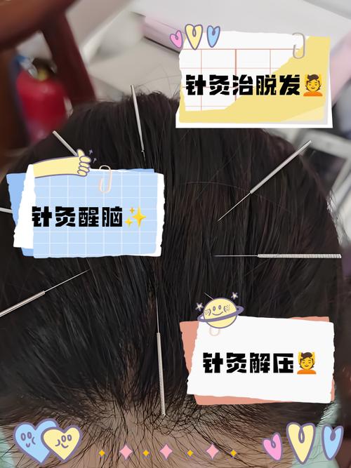 丘脑性疼痛针灸治疗