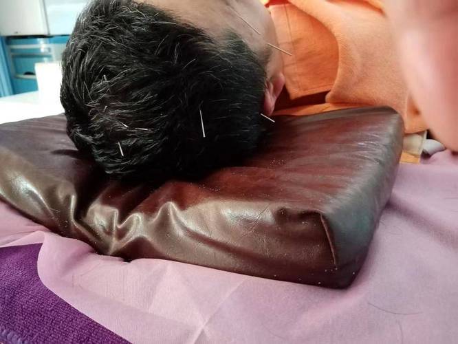 丘脑性疼痛针灸治疗