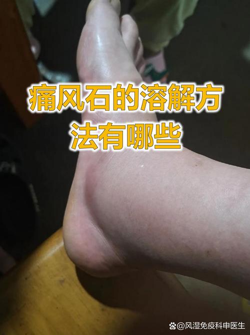 痛风石溶解是什么感觉