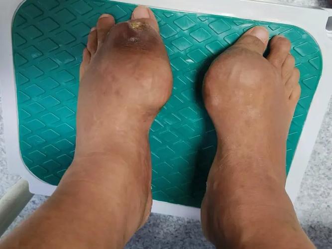 痛风石溶解是什么感觉