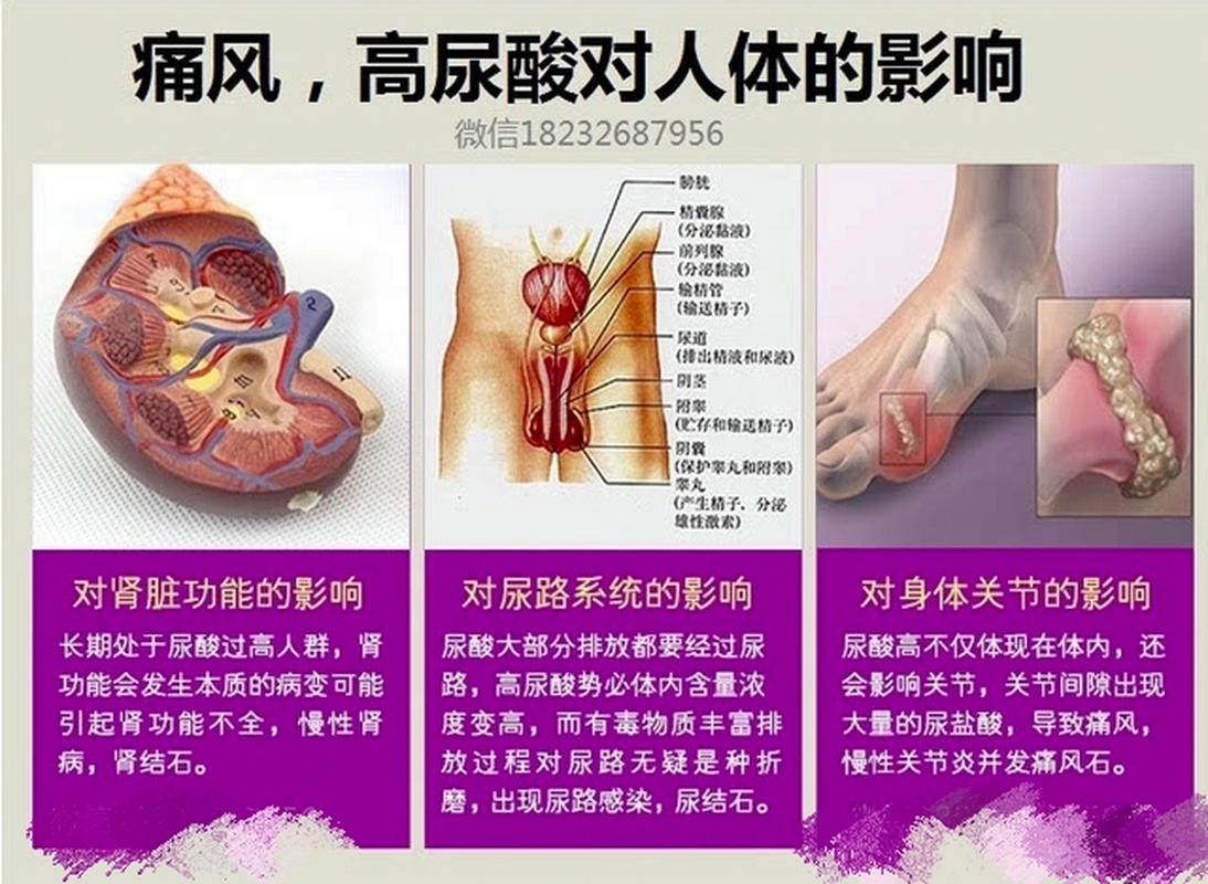 痛风怎么得的形成原因