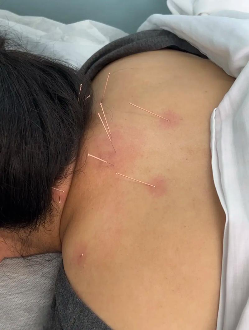 咸阳哪有针灸的地方