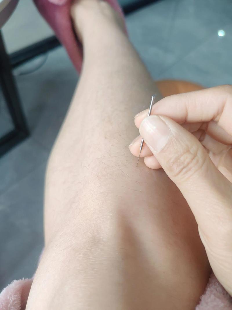 咸阳哪有针灸的地方