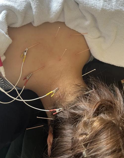 月经可以针灸颈椎吗