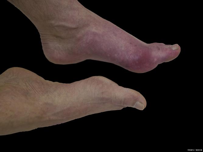 痛风前期的症状是什么