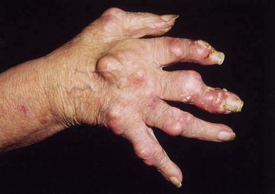 痛风前期的症状是什么