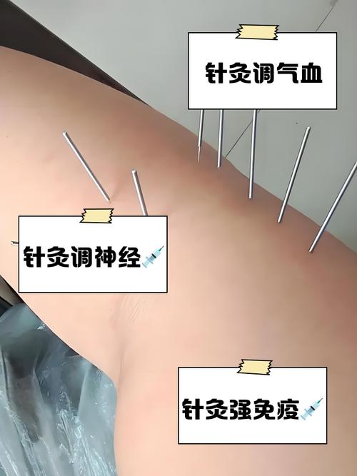 刚来月经可以针灸吗