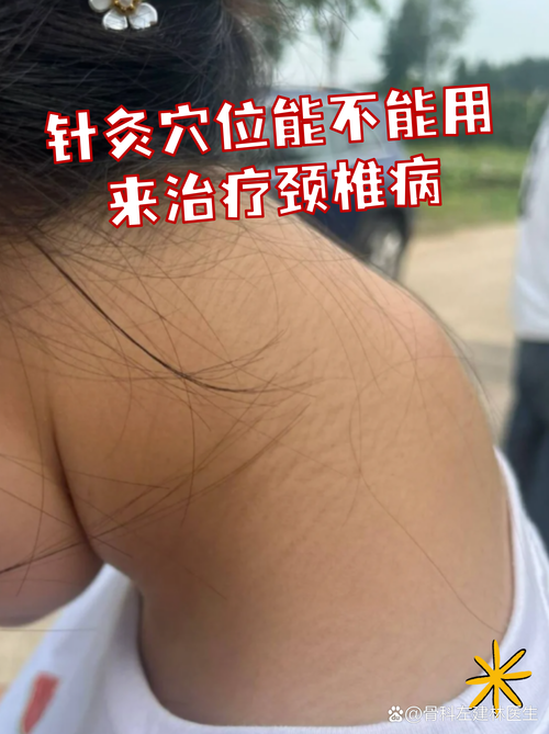 针灸可以治疗颈椎吗