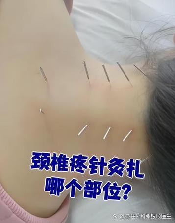 针灸可以治疗颈椎吗