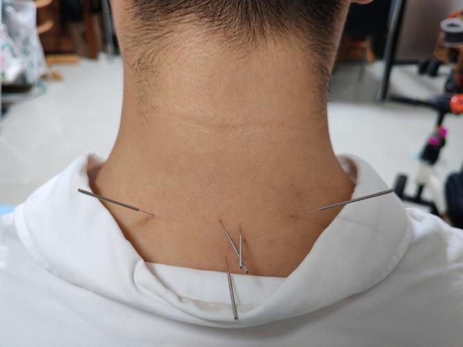 颈椎针灸后手臂酸痛