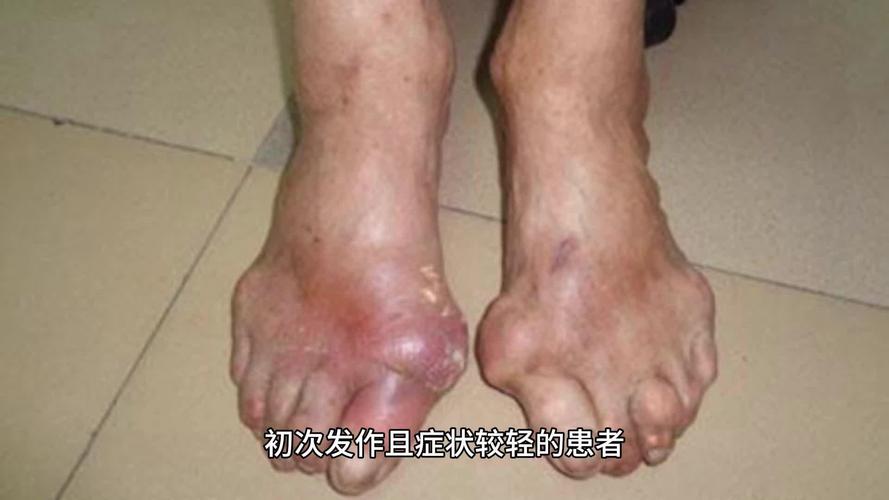 广州看痛风哪家医院好