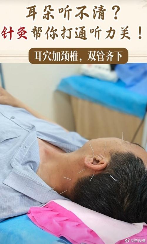 针灸治疗耳鸣的效果