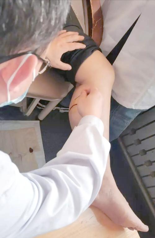 痛风放血疗法视频直播
