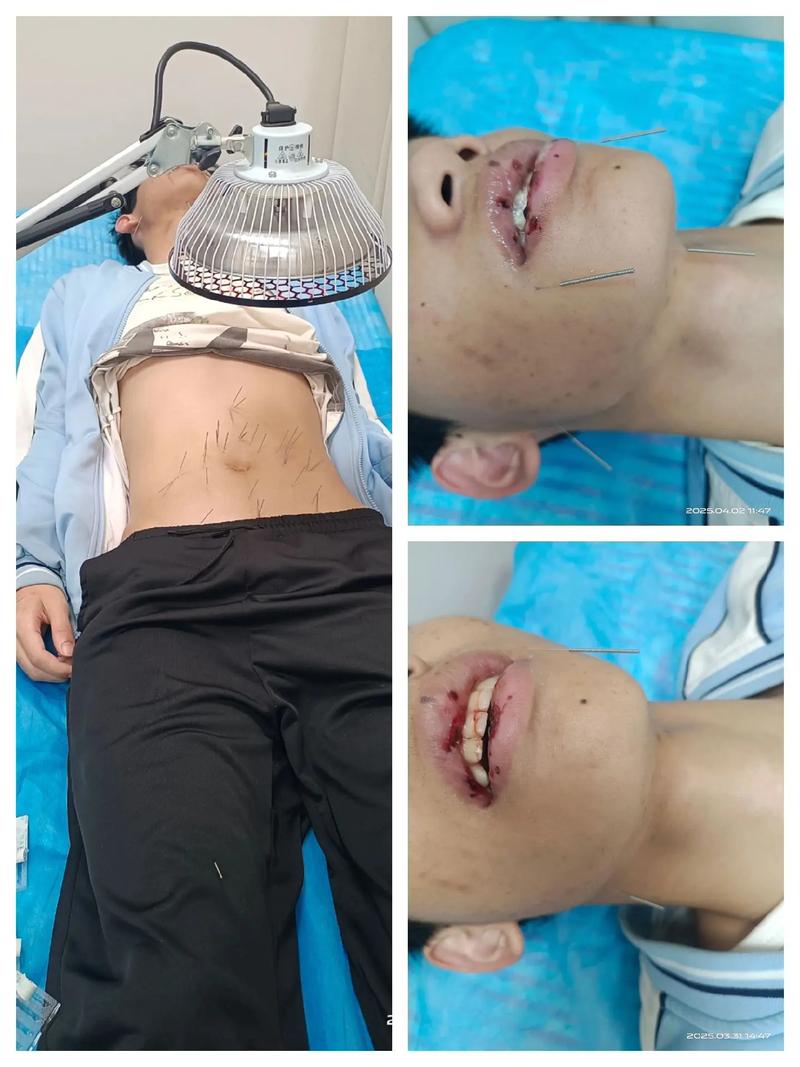 针灸治疗小孩说话迟