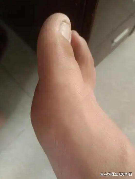 非布司他吃后痛风发作