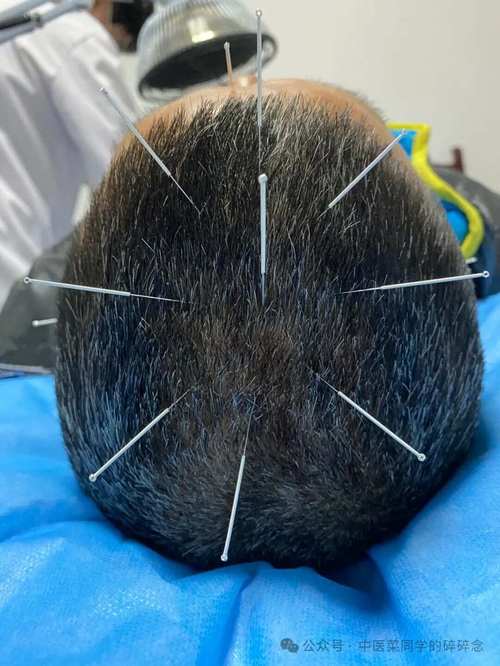 针灸对头晕效果好吗