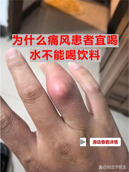 痛风能喝冰红茶饮料吗