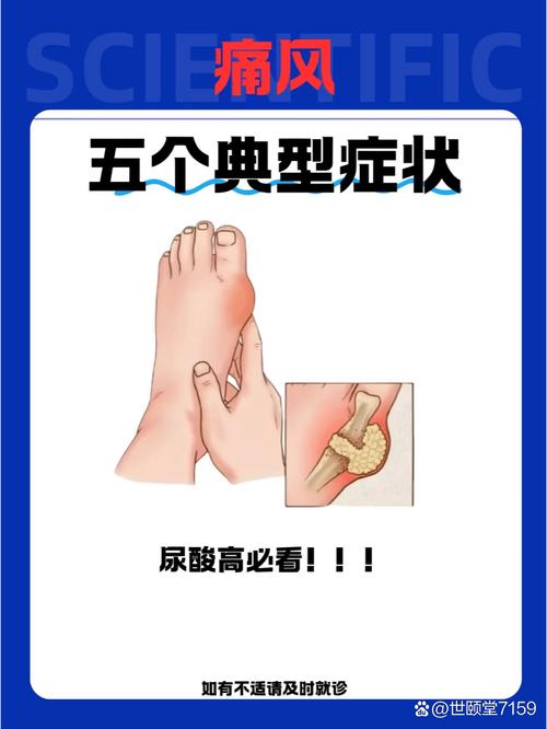 急性痛风发作的特点是