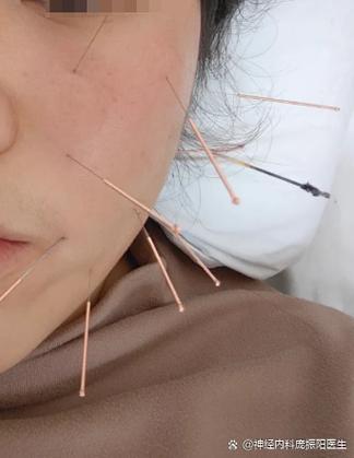 面瘫针灸后脸部僵硬