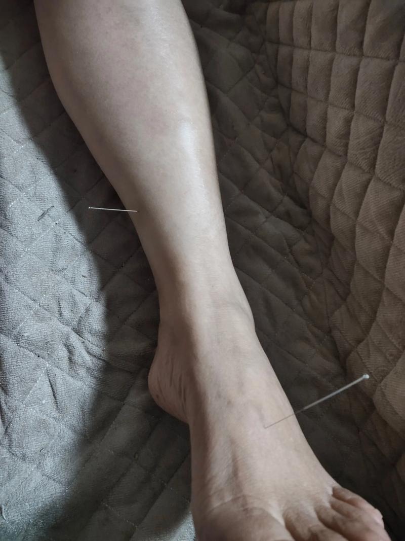 腿软无力可以针灸吗