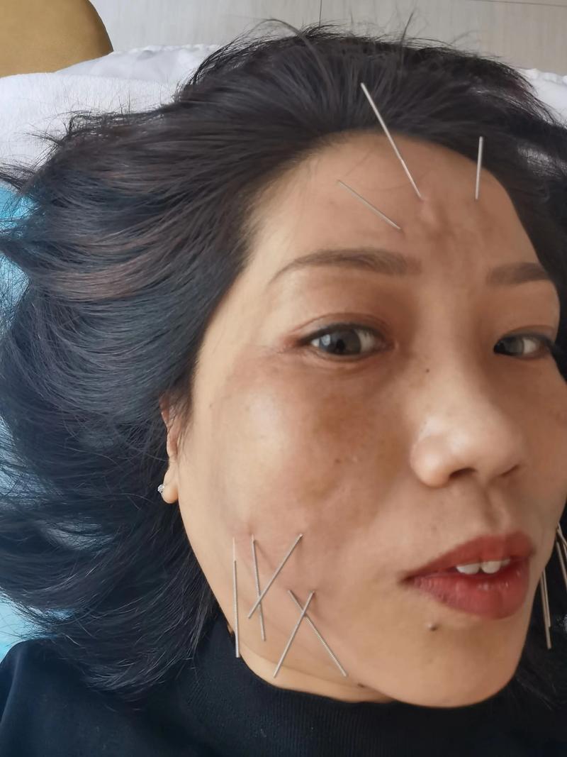 针灸可以改善肤色吗