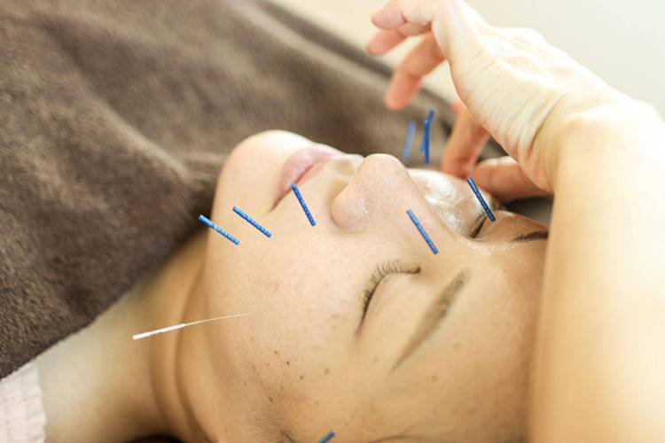 面瘫针灸后面部跳动