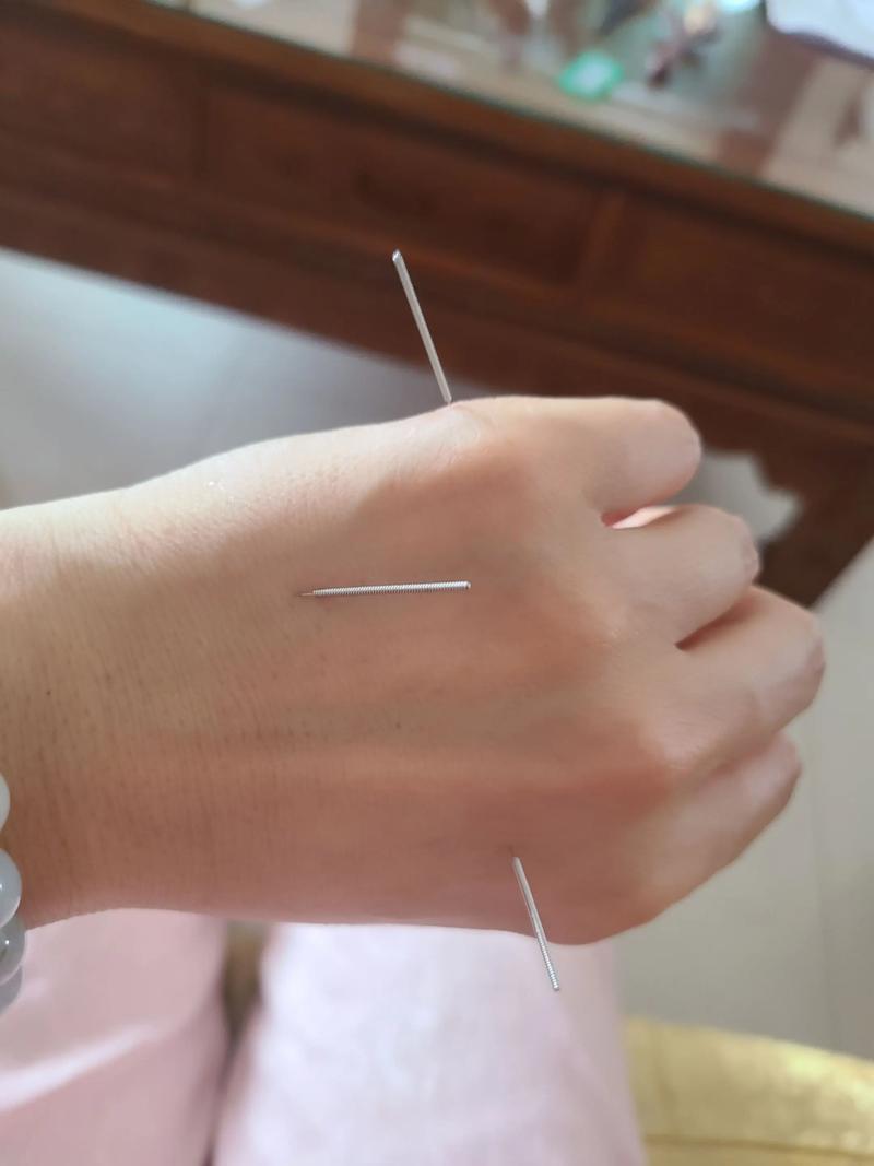 脖子落枕可以针灸吗