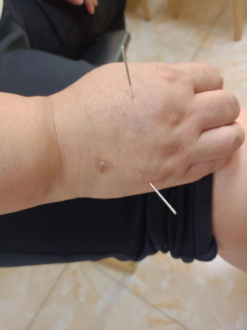 急性腰扭伤针灸哪里