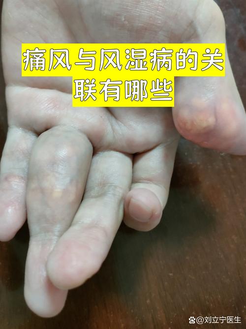 痛风和中风有什么区别