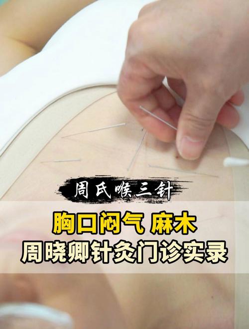 针灸治疗胸闷有效吗