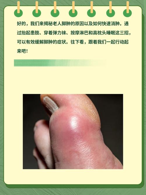 老人痛风脚肿怎么办了