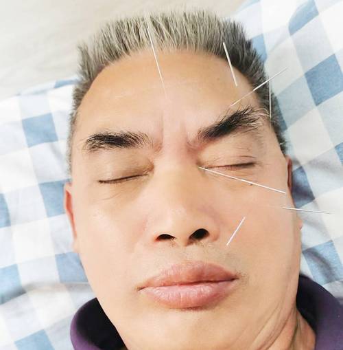 眼睑痉挛可以针灸吗