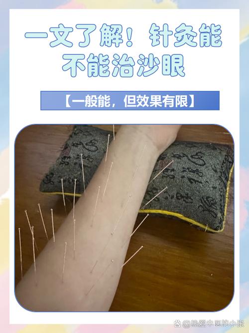 针灸可以治疗眼睛吗