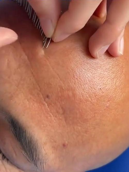 针灸去皱纹图片大全