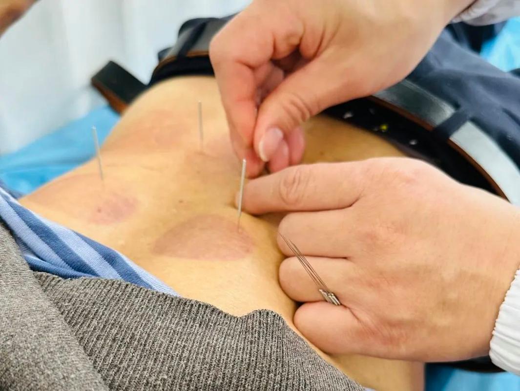 针灸尿失禁治疗方法