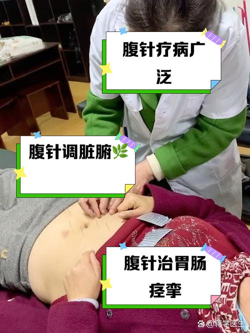 腹部针灸减肥有效吗