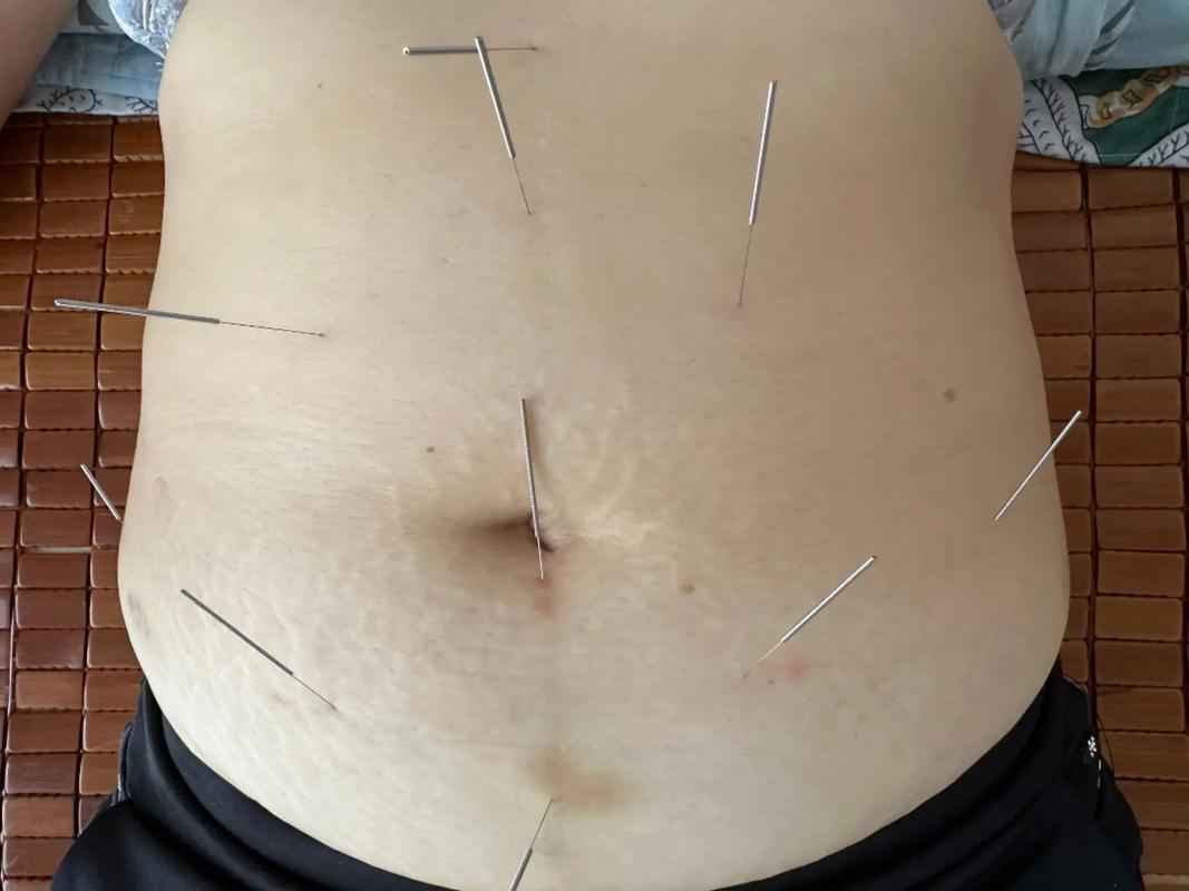 针灸过后全身冒凉气