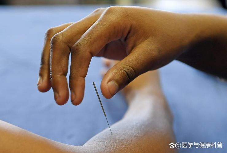 孕妇失眠用针灸调理