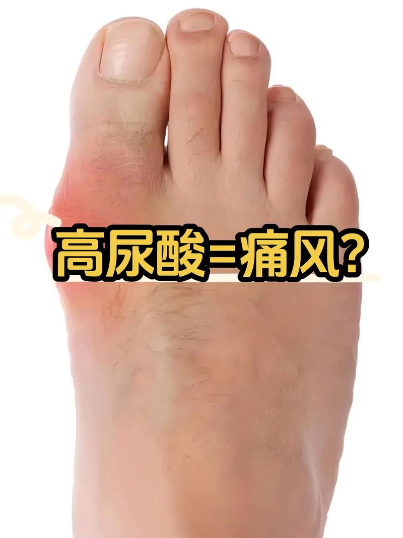 尿酸不高为啥还得痛风
