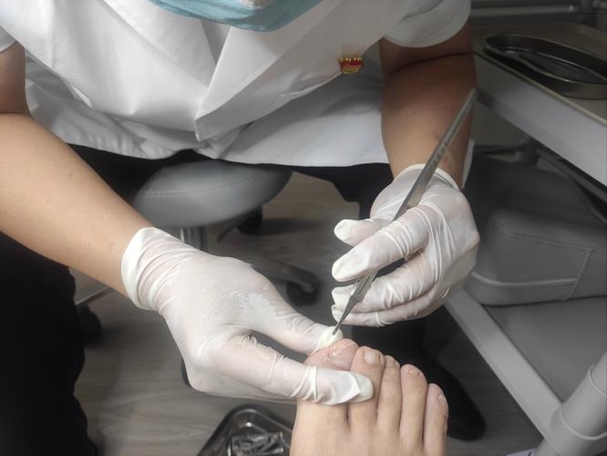 中医针灸治疗灰指甲