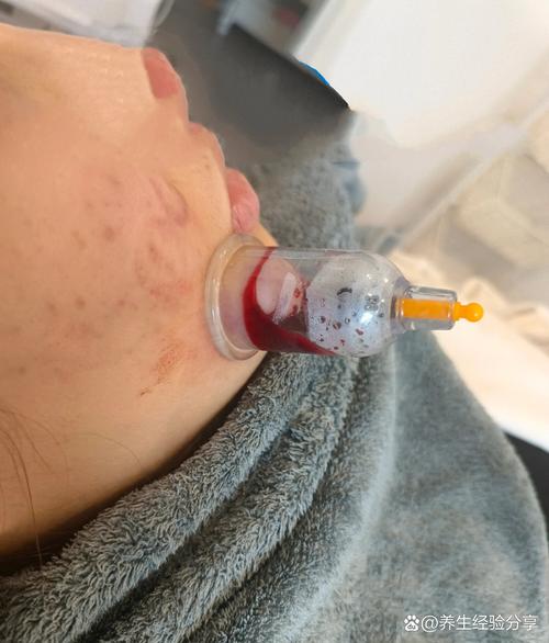 脸上长痘痘针灸放血