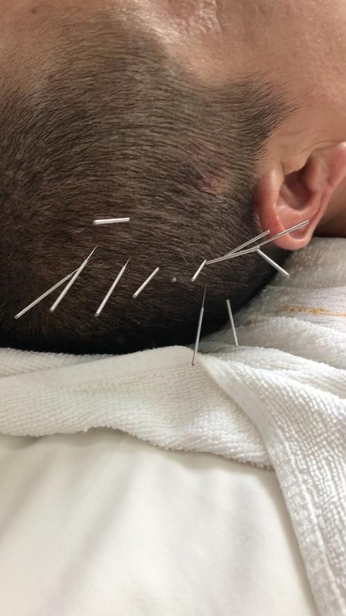 针灸治疗脑肿瘤瞎眼